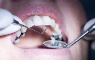 AMALGAME AL MERCURIO, METALLI PESANTI E CHELAZIONI NATURALI
