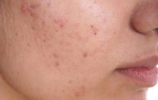 ACNE NODULO-CISTICA DA RISOLVERSI MEDIANTE SANGUE PURO E DEFLUSSO BILIARE