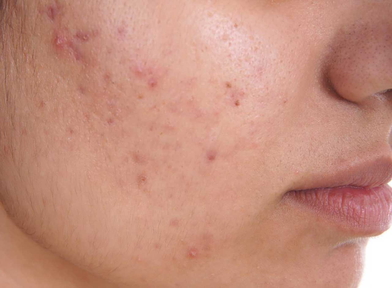 ACNE NODULO-CISTICA DA RISOLVERSI MEDIANTE SANGUE PURO E DEFLUSSO BILIARE