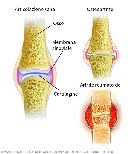 differenza artrite reumatoide e osteoartrite