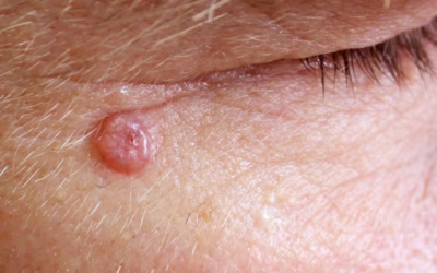 CARCINOMA BASO-CELLULARE DA RISOLVERSI SENZA ALCUNA PAURA