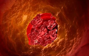 SINDROME CORONARICA ACUTA E RICADUTA NEL CIBO SPAZZATURA