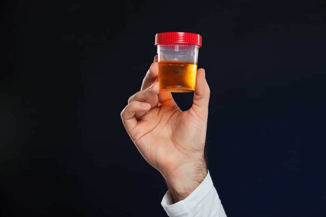 EMATURIA OVVERO SANGUE NELLE URINE