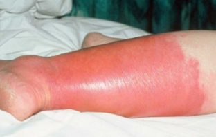ERISIPELA E LINFEDEMA, O CELLULITE SOTTOCUTANEA erisipela foto