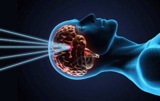 TRATTAMENTO ANTITUMORALE GAMMA KNIFE terapia gamma knife