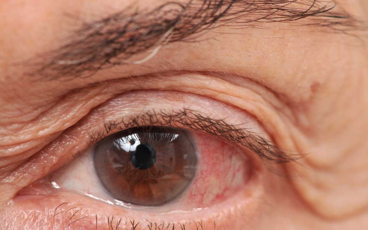 GLAUCOMA TERMINALE LADRO SILENZIOSO DELLA VISTA