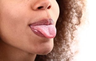 INFIAMMAZIONE PAPILLE GUSTATIVE O GLOSSITE donna con lingua fuori