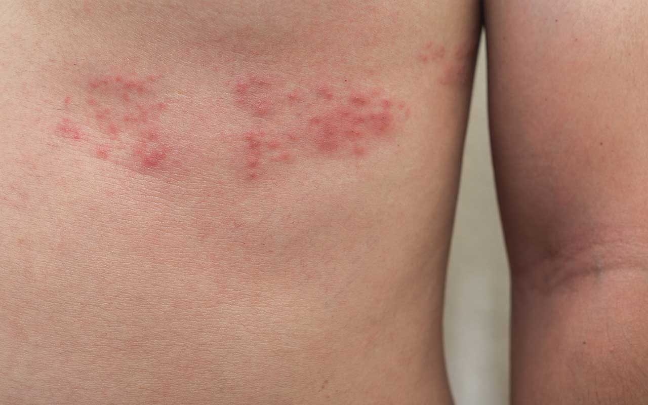 HERPES ZOSTER, FERITE E CICATRIZZAZIONI