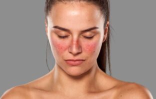 CURA VINCENTE DEL LUPUS