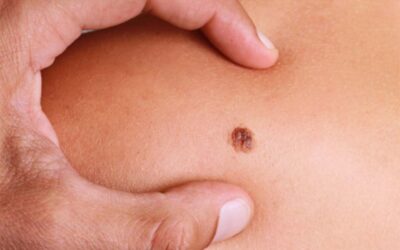 MELANOMA E SPINTE CUROMANI-MEDICALI VERSO L’INTERVENTO