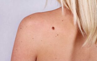 IL MELANOMA NON LO VEDO PIÙ, MA I DUBBI DA POST-OPERATO RIMANGONO