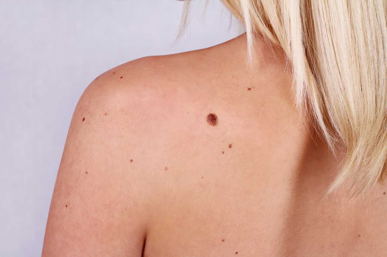 IL MELANOMA NON LO VEDO PIÙ, MA I DUBBI DA POST-OPERATO RIMANGONO