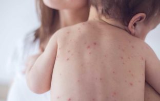 L’IMBROGLIO PLANETARIO DEL MORBILLO