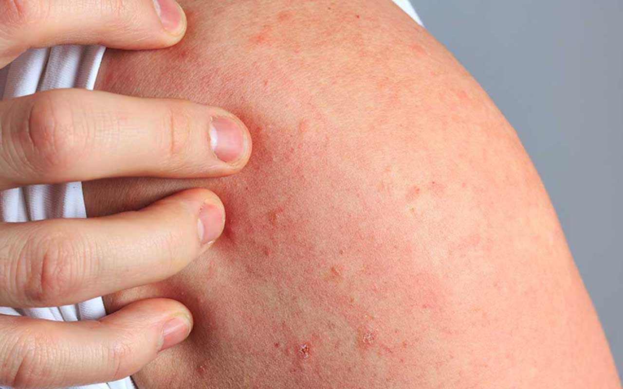 ORTICARIA: CAUSE, SINTOMI E RIMEDI NATURALI