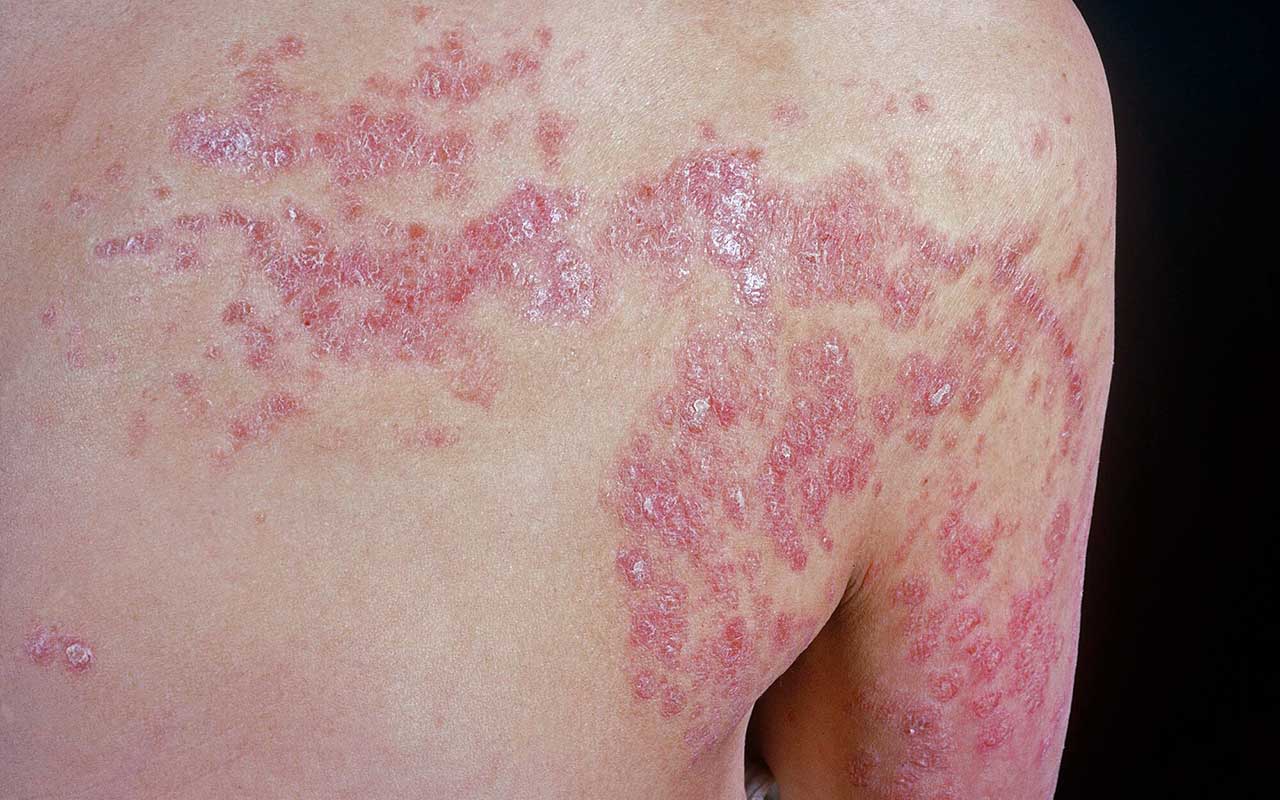 PSORIASI: SINTOMI, CAUSE E RIMEDI NATURALI