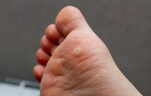 VERRUCHE, NEI ED IMPERFEZIONI DELLA PELLE